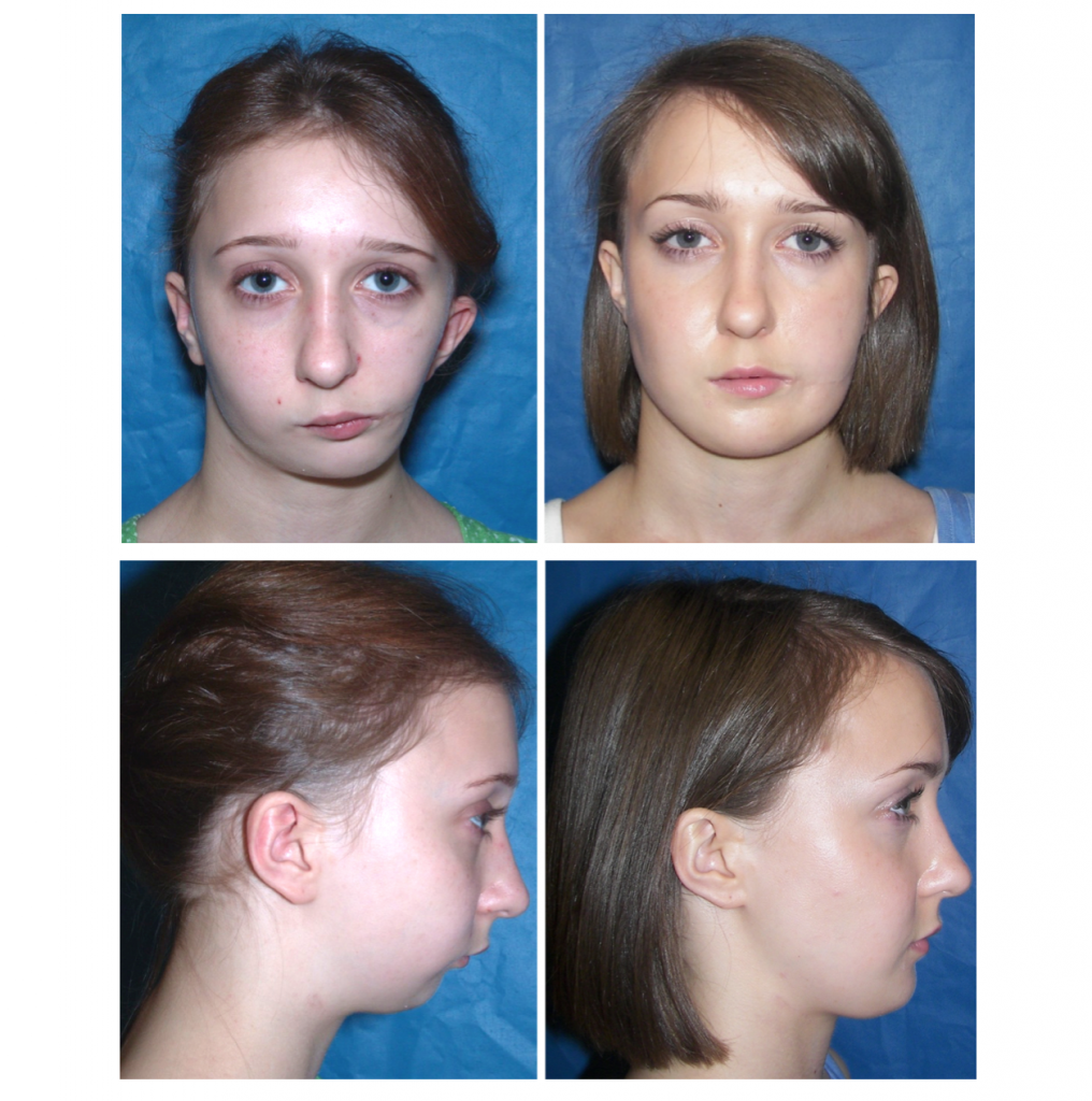 craniofacial hyperhidrosis treatment