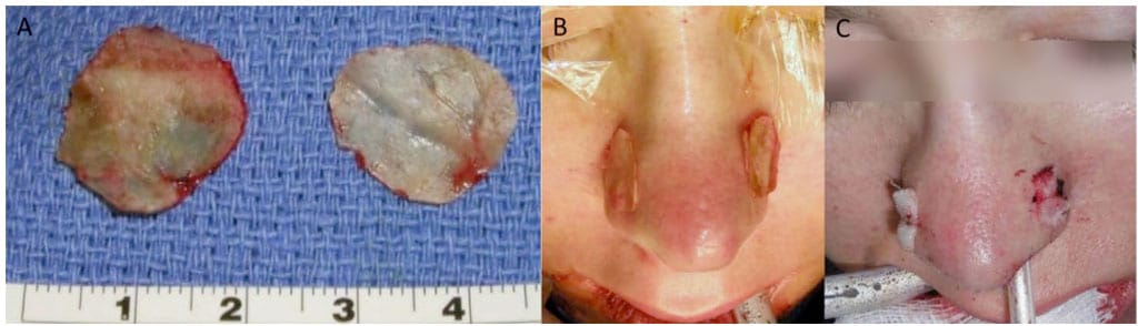 nasal-septum-surgery - Larry M. Wolford, DMD