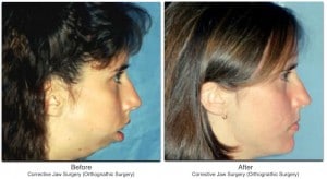Corrective Jaw Surgery (Orthognathic Surgery)