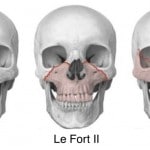Craniofacial Surgery Lefort Fractures