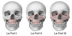 Craniofacial Surgery Lefort Fractures