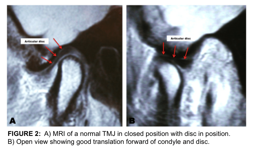 Mri Of A Normal Tmj In Closed Position With Disc In Position.