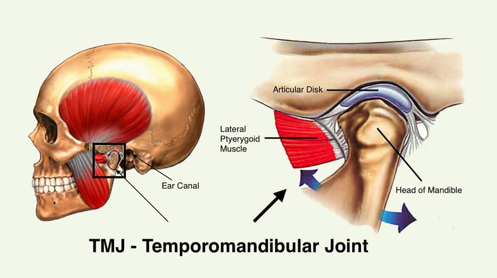 total temporomandibular joint (TMJ) replacement