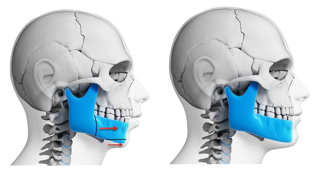 Mandibular Jaw Advancement | Orthognathic Surgery | Dr. Larry M. Wolford, Dmd