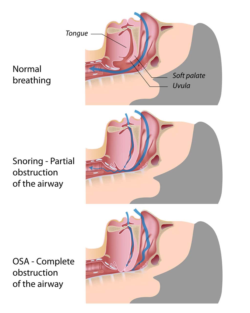 why-do-i-snore-snoreeze-snoring-relief