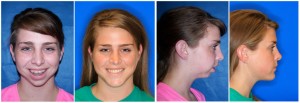 Before And After Surgery Photos
