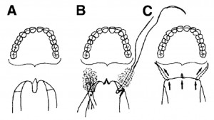 Uvulopalatopharyngoplasty (Uppp)