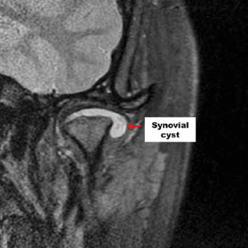 Dr Wolford Removes Synovial Cyst