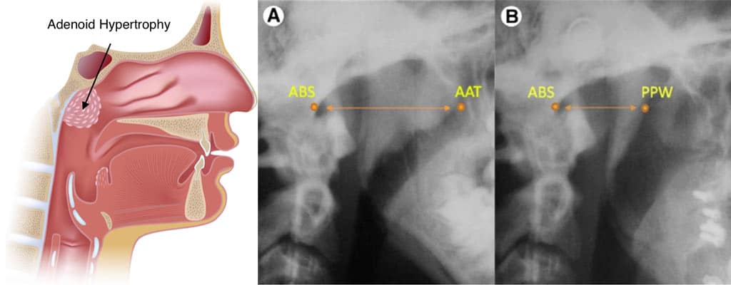 Adenoid Hypertrophy Patient Uk Adenoid Hypertrophy Patient Uk