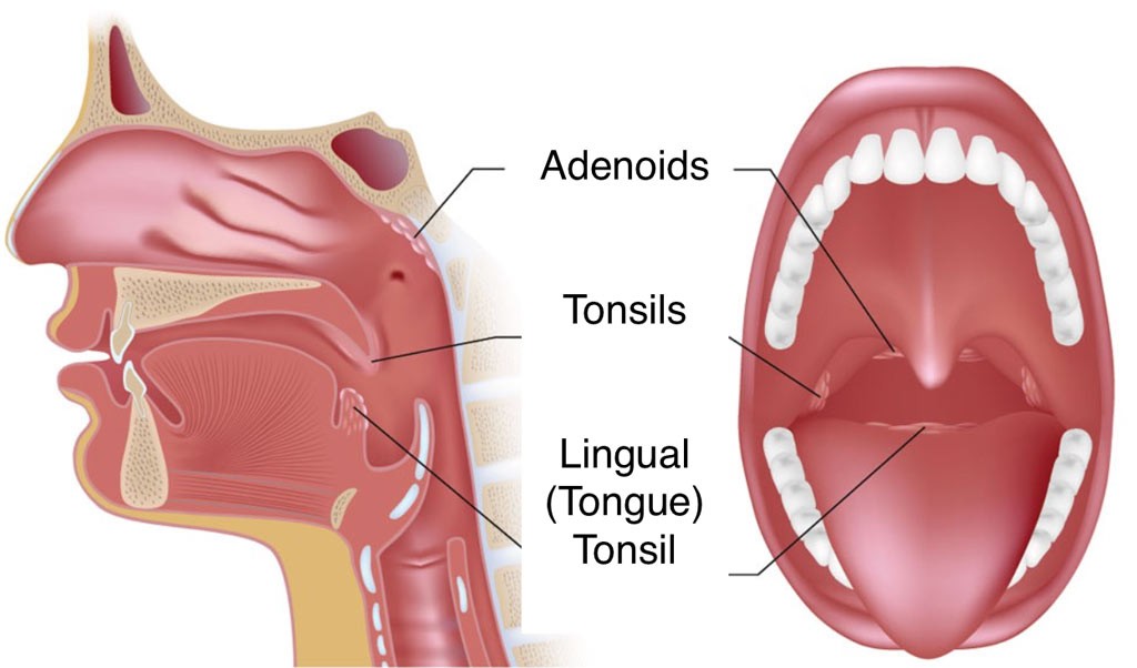Adenoids And Tonsils Enlarged