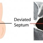 Dr Wolford Treats Deviated Septum