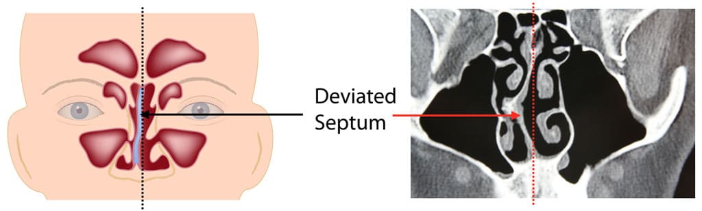 Dr Wolford Treats Deviated Septum