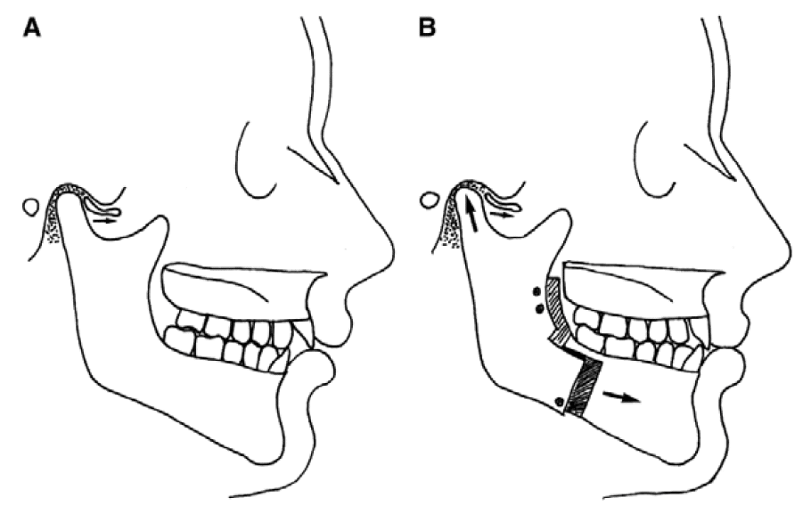 Mandible Is Advanced Without Tmj Surgery