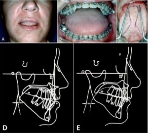 Large Tongue Surgery