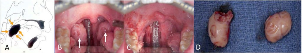 Tonsil Senlarged