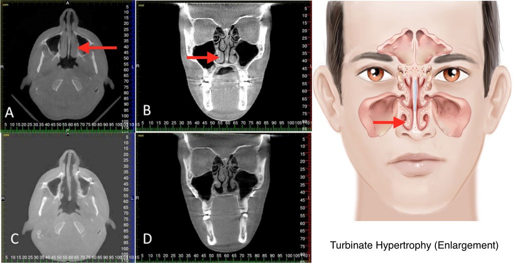 Hypertrophied Turbinates With Significant Nasal Airway Obstruction