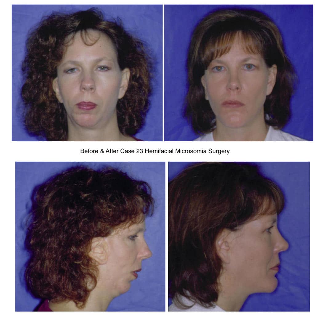 Womn Before And After Hemifacial Microsomia