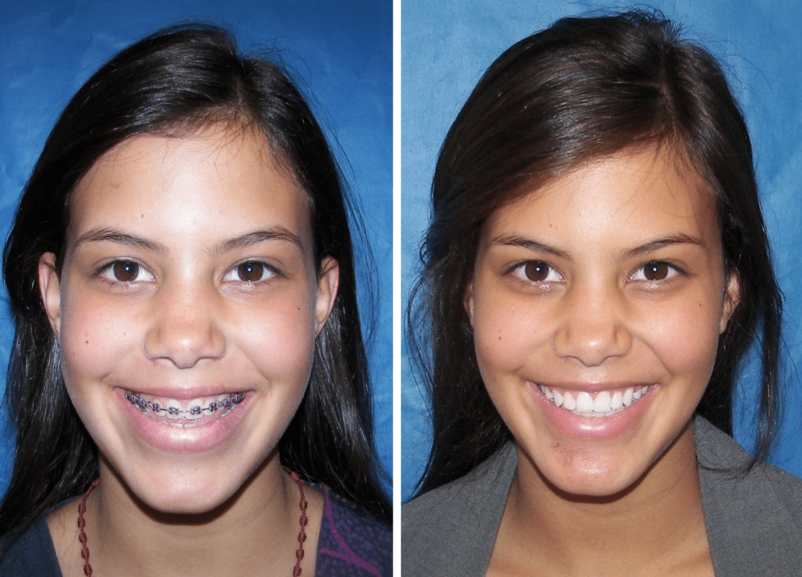 Before &Amp; After Case 13 Mandible Surgery