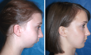 Before After Case 25B Hemifacial Microsomia Surgery