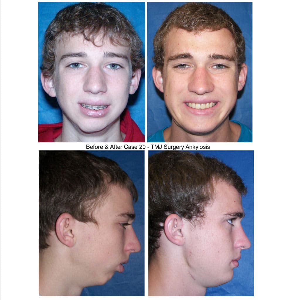 Before &Amp; After Tmj Surgery Ankylosis