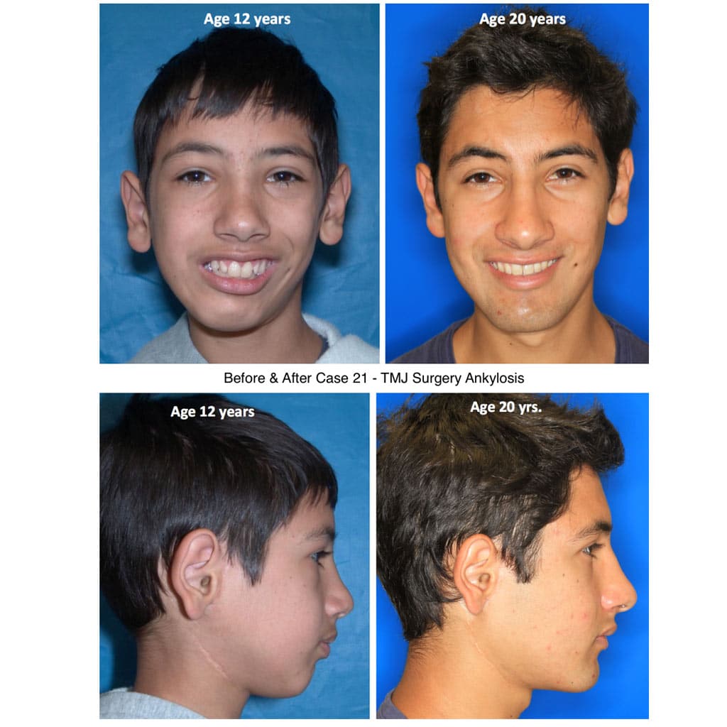 Before &Amp; After Tmj Surgery Ankylosis