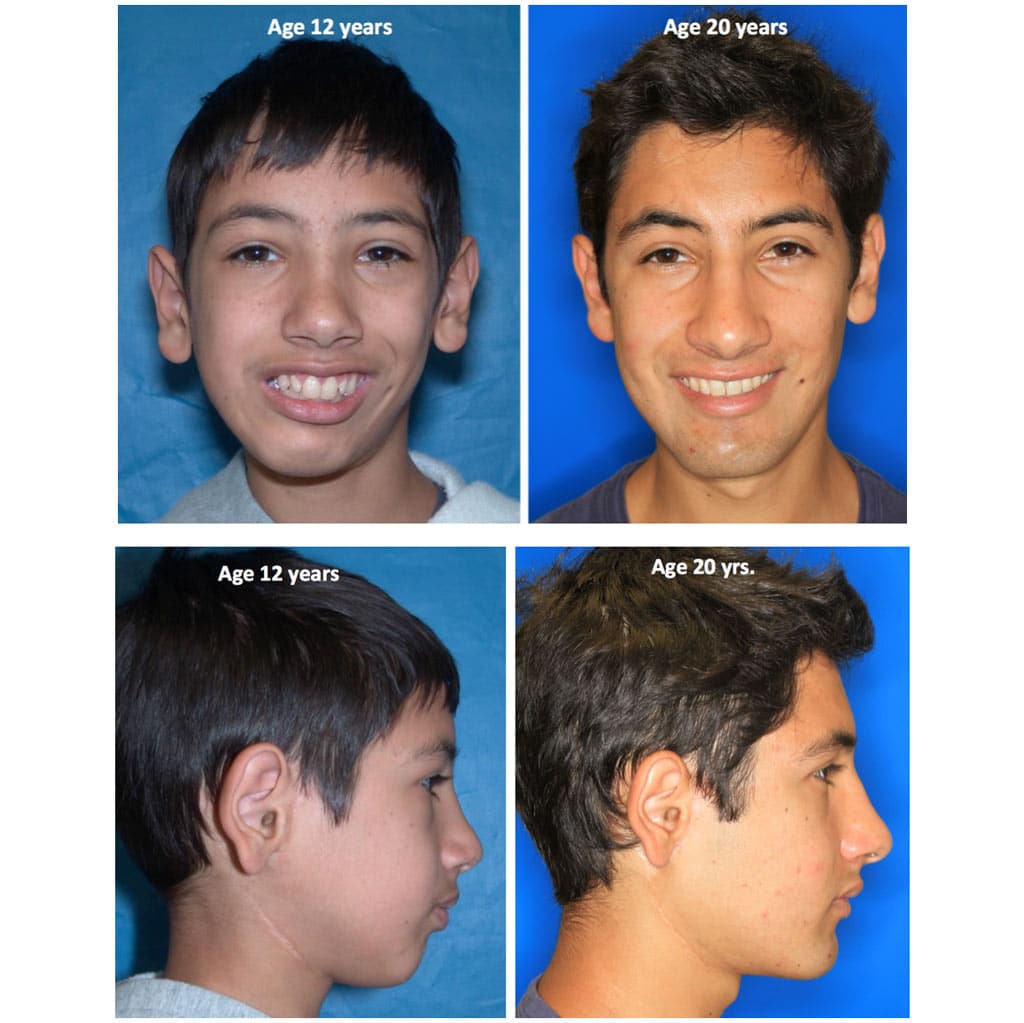 Before And After Tmj Surgery Ankylosis