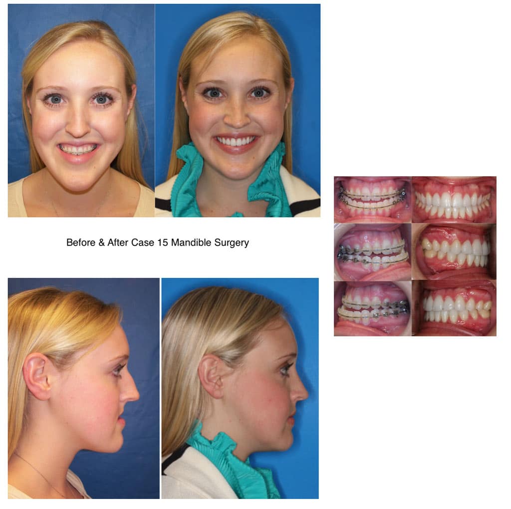 Girl Before And After Mandible Corrective Jaw Surgery