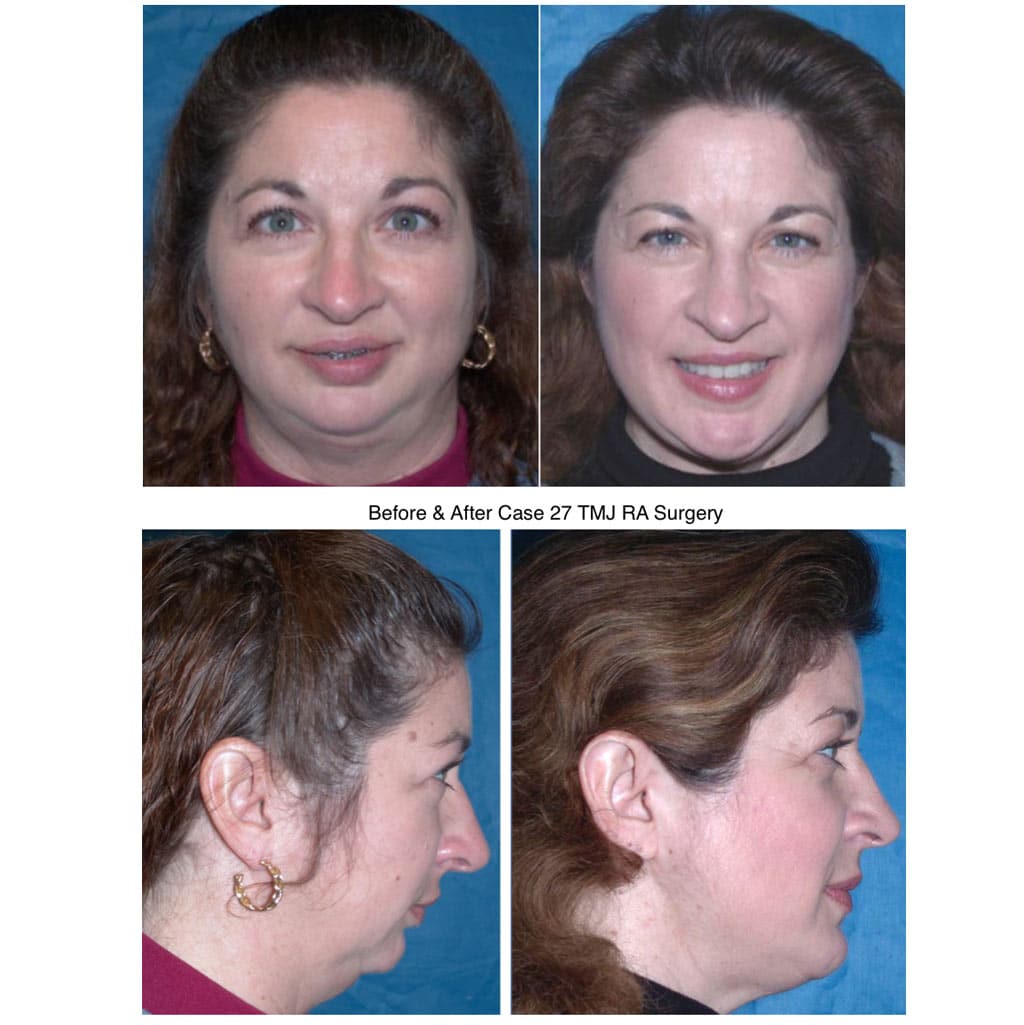 Woman Before &Amp; After Tmj Ra Surgery