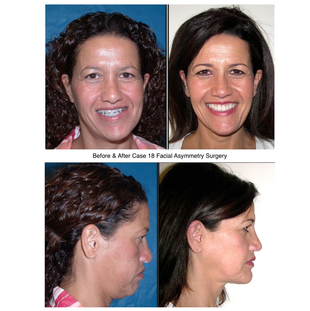 Woman Before And After Facial Asymmetry Surgery