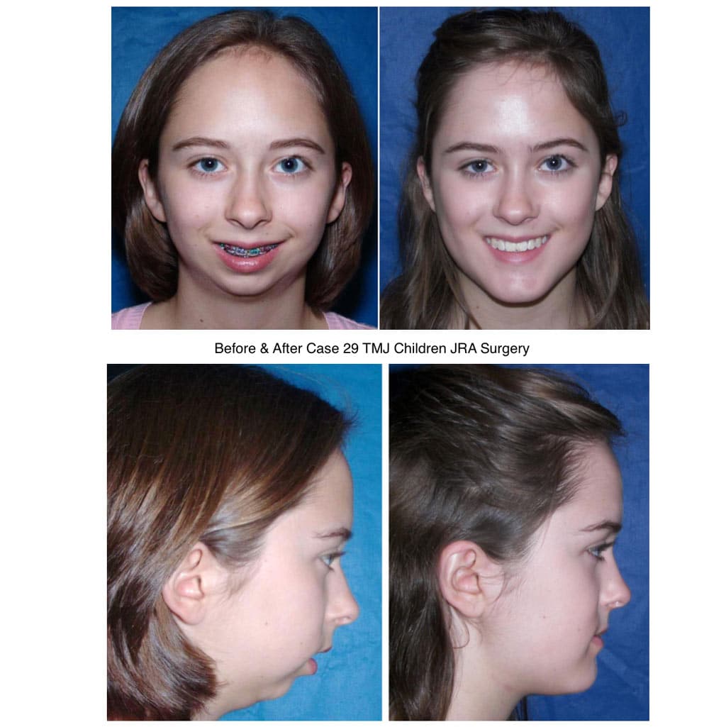 Before &Amp; After Tmj Children Jra Surgery - Girl