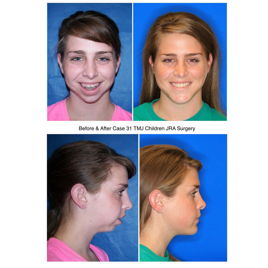 Girl Before &Amp; After Tmj Children Jra Surgery
