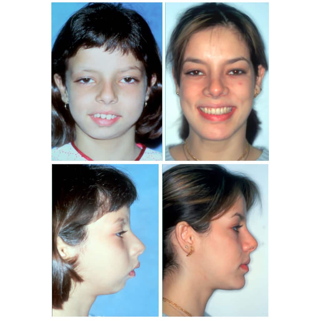 Girl Before And After Hemifacical Microsomia
