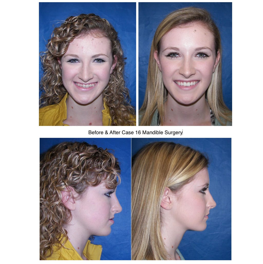 Girl Before And After Mandibles Corrective Jaw Surgery