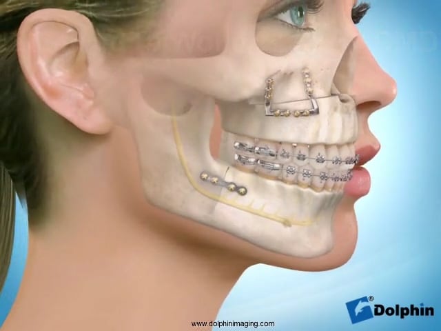 Maxillary Advancement With Mandibular Setback | Dr Wolford Maxillofacial Jaw Surgeon