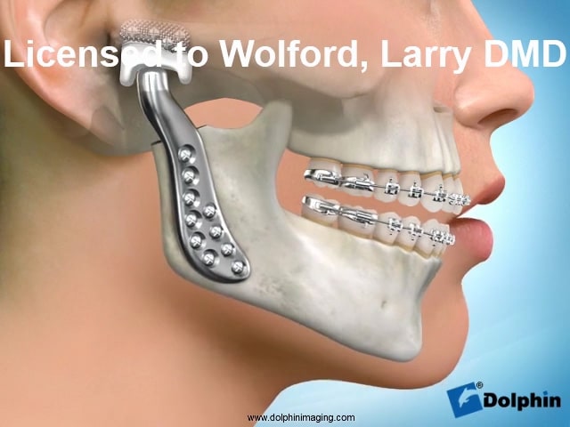 Total Joint Replacement (Tmj) | Dr Wolford Maxillofacial Jaw Surgeon