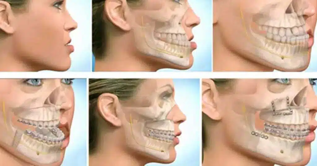 Why People Choose Corrective Jaw Surgery Revision