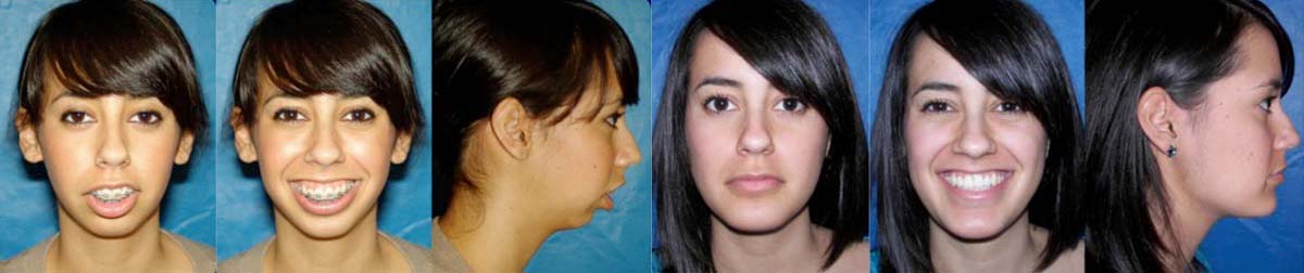 Before &Amp; After Surgery Photos Of Dr. Wolford'S Maxillofacial Revision - Slide 3