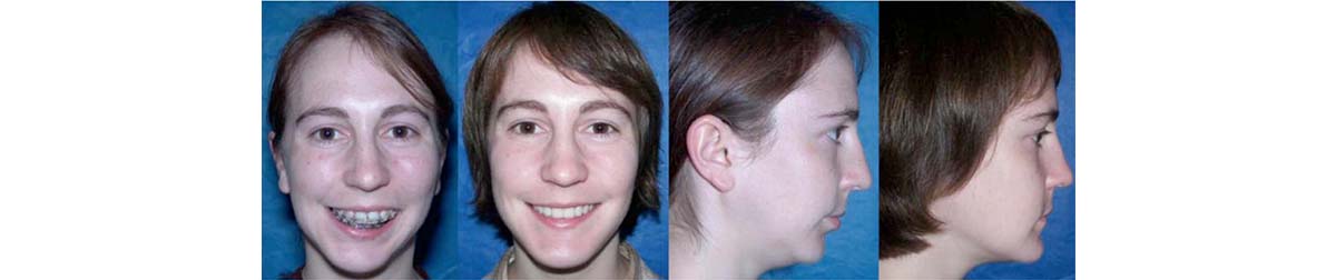Before &Amp; After Surgery Photos Of Dr. Wolford'S Maxillofacial Revision - Slide 4